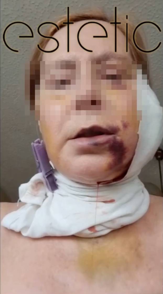 Na istog se estetskog kirurga žalila i Kristina Mandarina. Pogledajte kako je izgledala