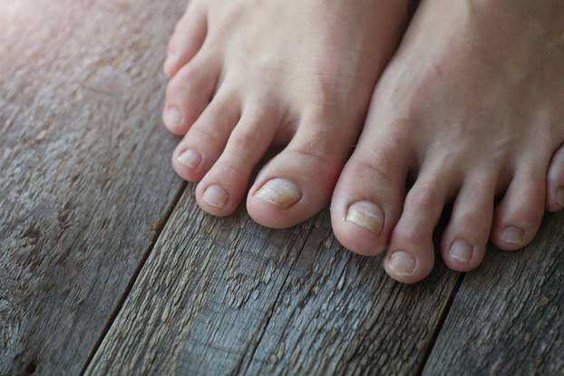 Close-up of legs with fungus on nails on wooden background. 