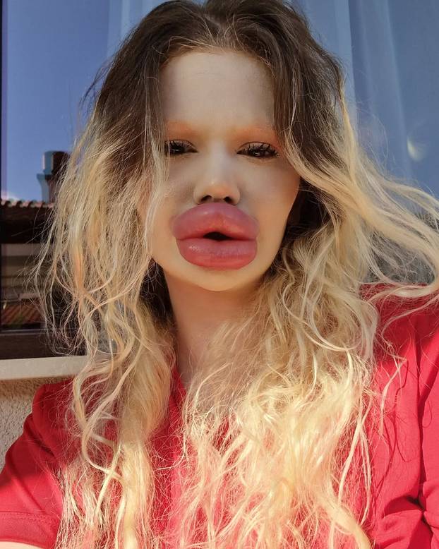 FOTO Žena s najvećim usnama na svijetu otkrila kako je nekoć izgledala: Šok! Bila si prekrasna