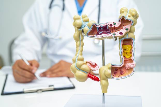 Intestine,,Appendix,And,Digestive,System,,Doctor,Holding,Anatomy,Model,For