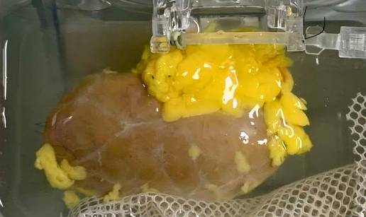 SENZACIONALNO Jedan bubreg za sve! Otkrili su kako 'brisati' krvne grupe, rezultati su čudo!