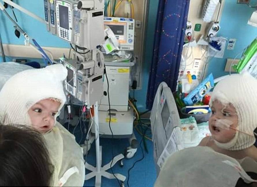 Dirljivo! Sijamski blizanci prvi put ugledali jedan drugome lice