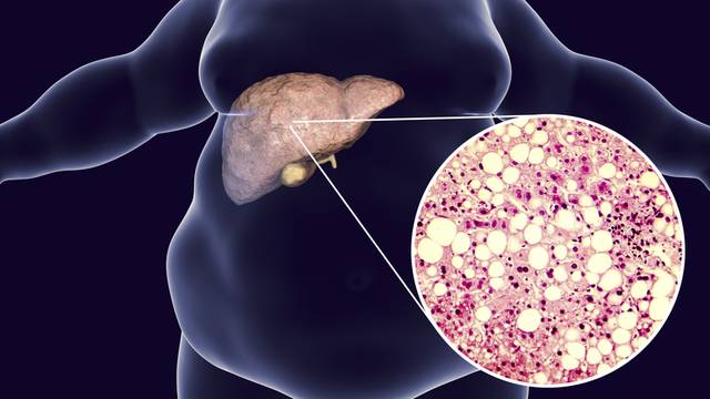 Simptomi masne jetre su tihi, a izaziva rak, moždani udar...