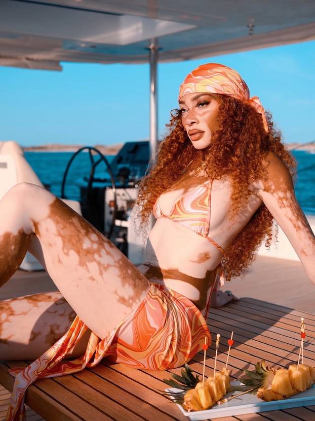 FOTO Rugali su joj se zbog bolesti, a danas je obožavaju zbog jedinstvenog izgleda