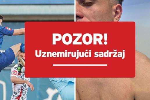 FOTO Ovako izgleda lice Lučića nakon opasnog starta Galešića