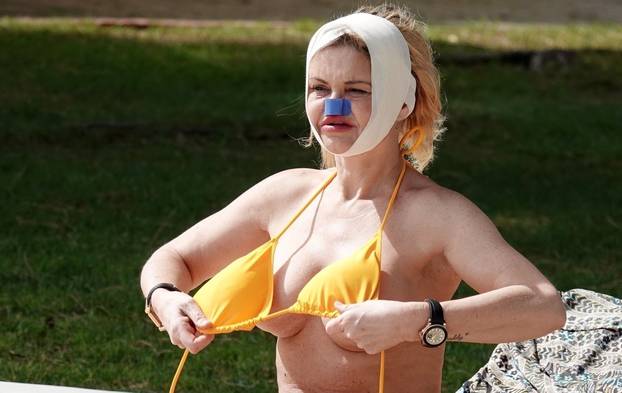 *PREMIUM-EXCLUSIVE* *MUST CALL FOR PRICING* Former Eastenders Actress Danniella Westbrook underwent life-changing surgery to rebuild her face as the star was sunbathing with bandages around her head and nose out in Turkey.