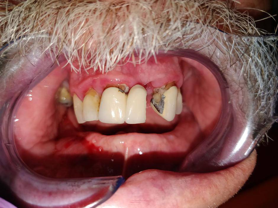 Do zubnog implantata u 72 sata bez obzira na stanje kosti