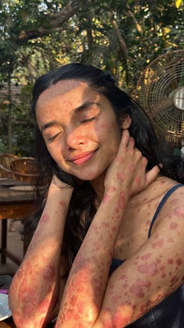 EXCLUSIVE: ‘95% of my skin is covered by psoriasis but I’ll never hide my body,’ says woman, 22