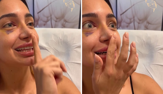 FOTO Sve za ljepotu! Naši slavni ne boje se ići 'pod nož': Sredili su grudi, usne, presađuju kosu