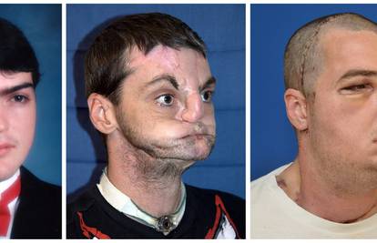 Skrivao se 15 godina: Ima novo lice, jezik, zube i čeljust