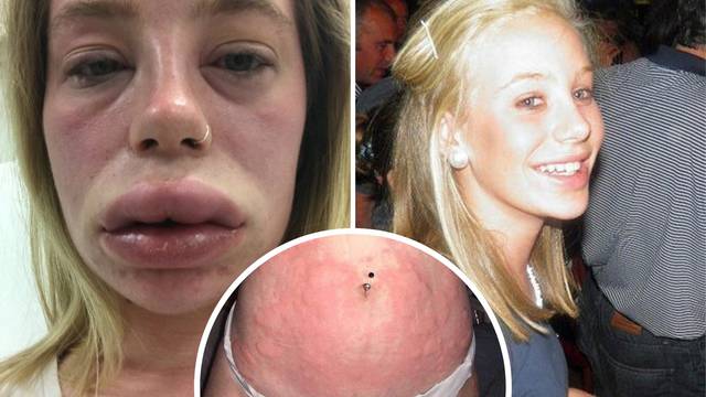 Misteriozni poremećaj: Usne joj tako nateknu da ne može disati
