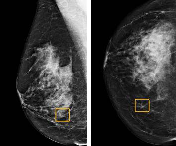 Novi program bolji u dijagnozi raka dojke od samih radiologa