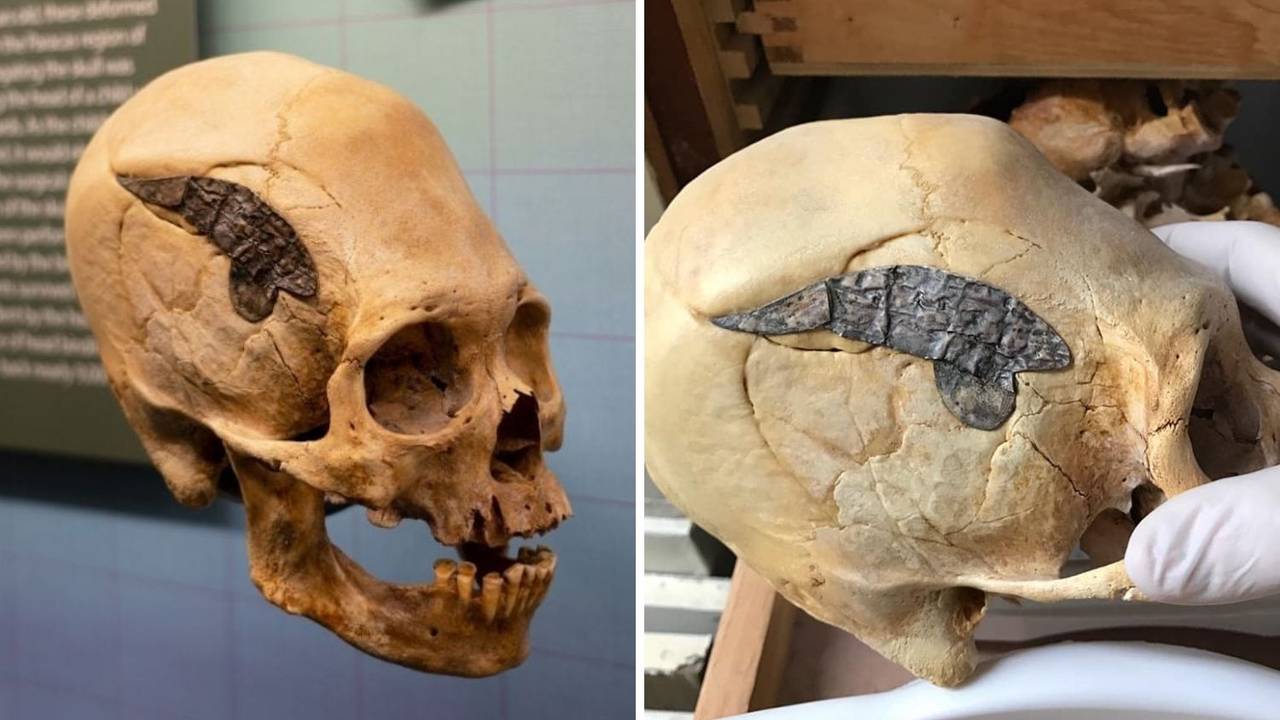 Prije 2000 godina ratniku koji je ozlijeđen u borbi ugradili su metalni implantat u lubanju | 24sata
