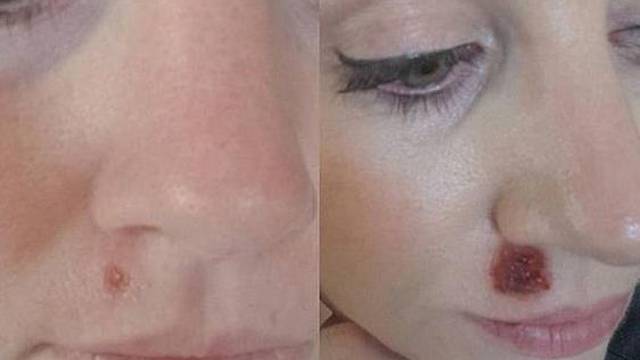 Rak kože: Mali obični prištić na licu ju je mogao stajati života