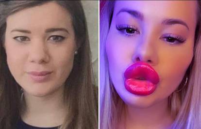 'Želim izgledati poput Barbie, ali roditelji više ne pričaju sa mnom zbog plastičnih operacija'