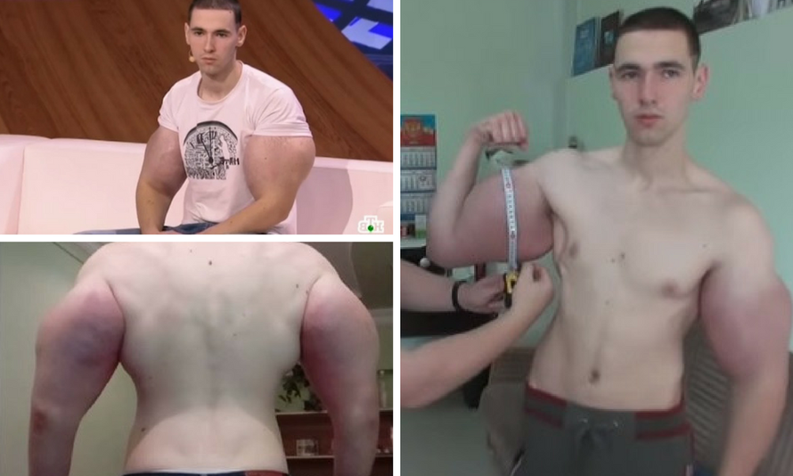 'Uzgojio' divovske mišiće radi slave: 'Amputirat će mu ruke'