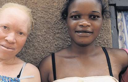 Albino ljudi: Ubijaju ih jer su uvjereni da im to donosi sreću