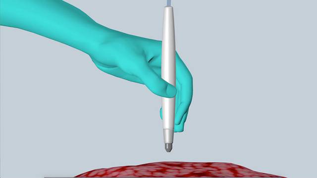 Ova 'olovka' može u samo 10 sekundi otkriti imate li  tumor