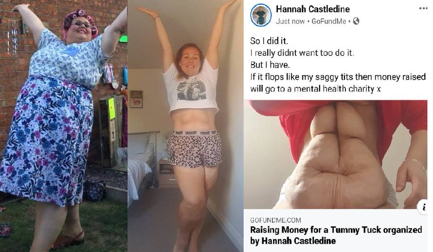 Ozbiljno je shvatila upozorenje liječnika, skinula 63 kg, ali sad joj je ostalo 7 kg viseće kože