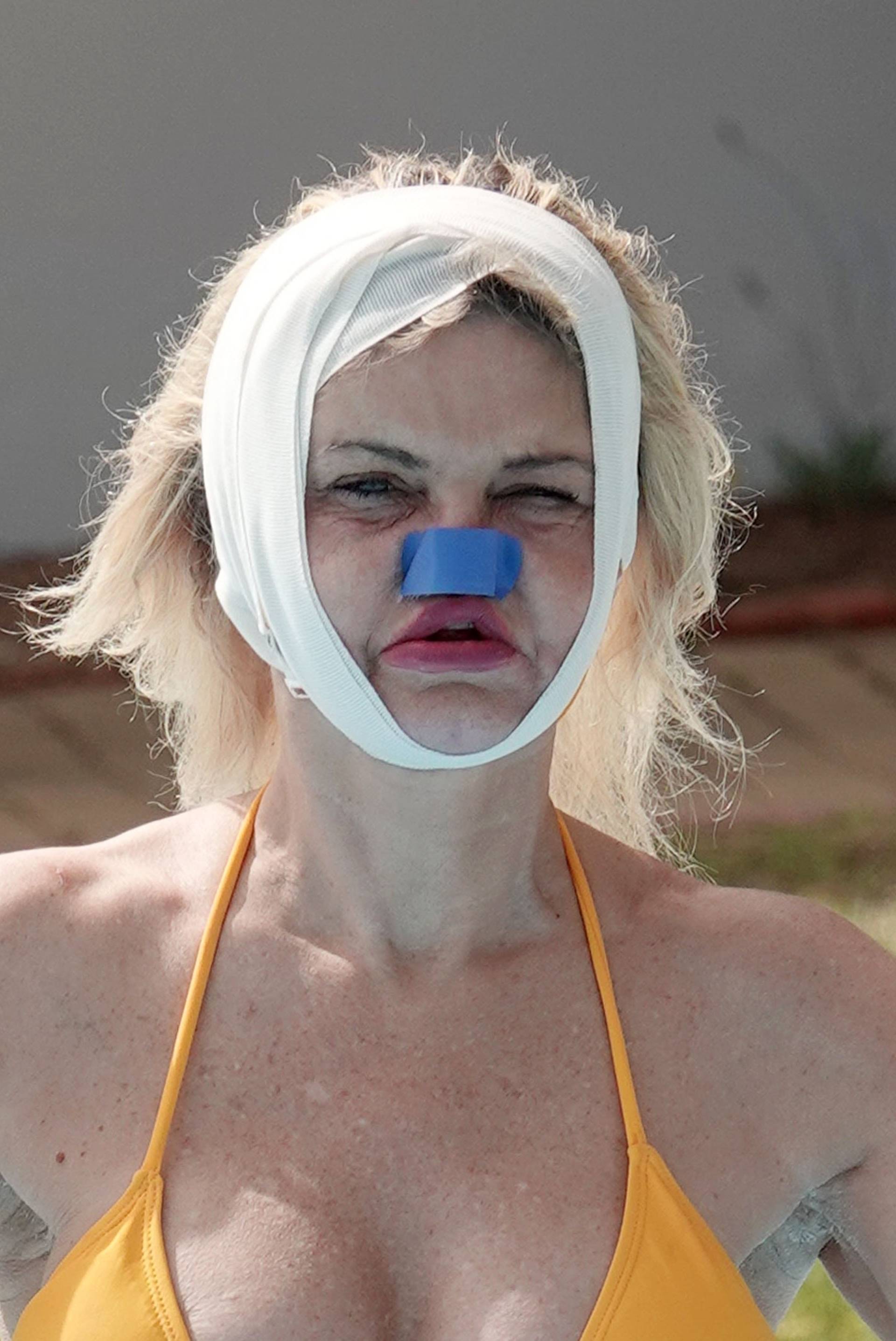 *PREMIUM-EXCLUSIVE* *MUST CALL FOR PRICING* Former Eastenders Actress Danniella Westbrook underwent life-changing surgery to rebuild her face as the star was sunbathing with bandages around her head and nose out in Turkey.