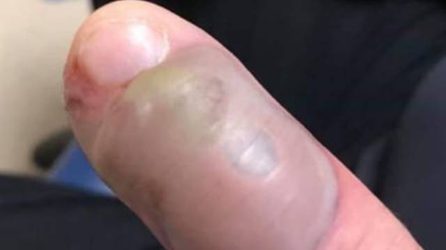 Grizao nokte pa zaradio odurnu smrtonosnu infekciju na prstu