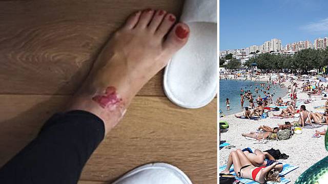 Rumunjka Monika: Na splitskoj plaži zmija me ugrizla u venu! Noga mi je postala duplo veća