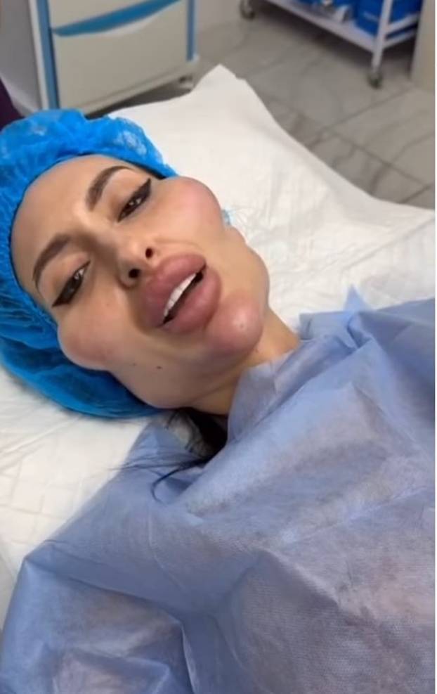 Žena s 'najvećim obrazima na svijetu' objavila fotografiju iz mladosti: 'Šok! Šteta ljepote'