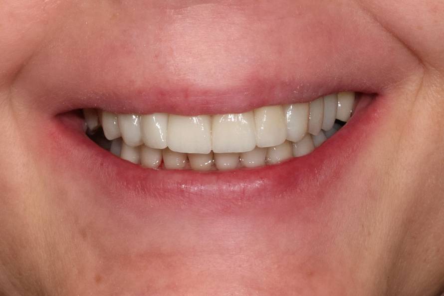 Osmijeh koji izgleda prirodno? Tajna je u preciznom planiranju i kvalitetnom materijalu