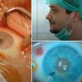 Mladi hrvatski doktor osmislio novu metodu za operaciju očiju