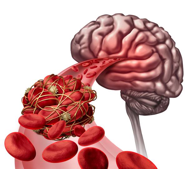 Brain Blood Clot