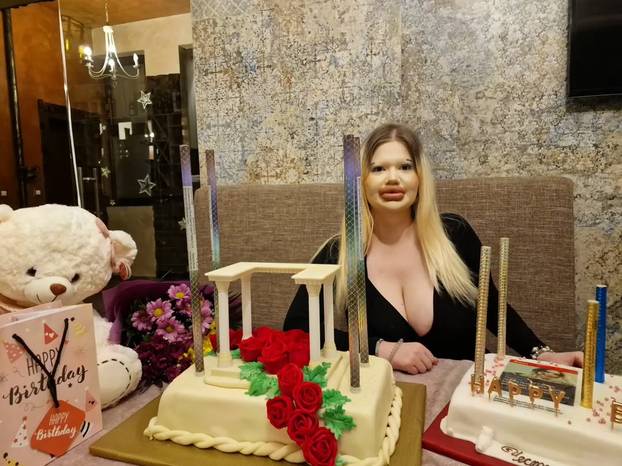 FOTO Žena s najvećim usnama na svijetu otkrila kako je nekoć izgledala: Šok! Bila si prekrasna