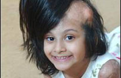 Opečena djevojčica nakon tri godine dobit će kosu