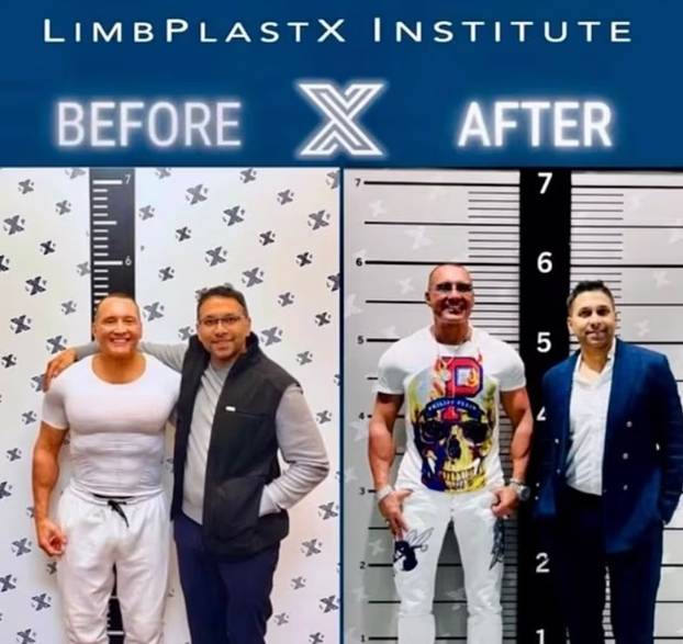 FOTO Odvjetnik platio 70.000 € da mu noge produže 10 cm i želi još: 'Nižim muškarcima je teže!'