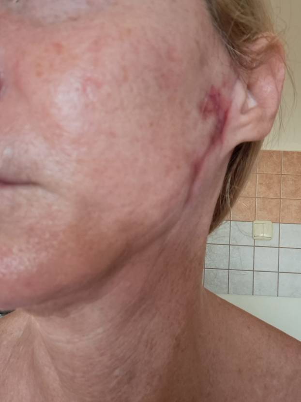 Na istog se estetskog kirurga žalila i Kristina Mandarina. Pogledajte kako je izgledala