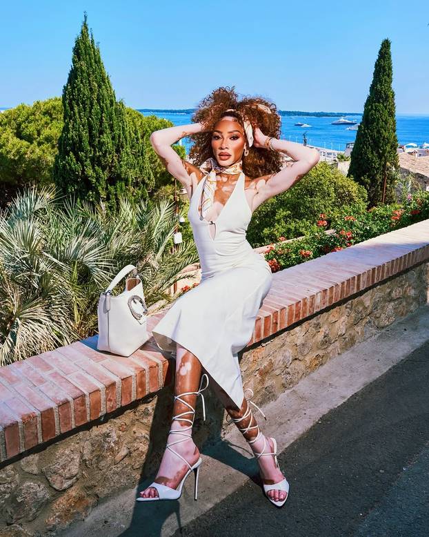 FOTO Rugali su joj se zbog bolesti, a danas je obožavaju zbog jedinstvenog izgleda