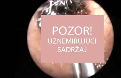 Jezivi slučaj: 'Iz uha smo joj izvadili više od tisuću mrava!'