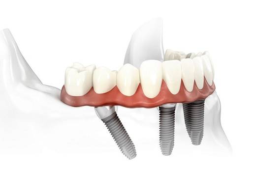 Novi zubi u jednom danu: Tko mo&zcaron;e, a tko ne?