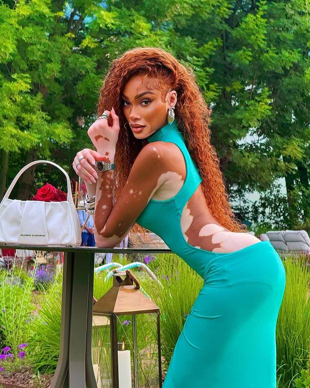 FOTO Rugali su joj se zbog bolesti, a danas je obožavaju zbog jedinstvenog izgleda