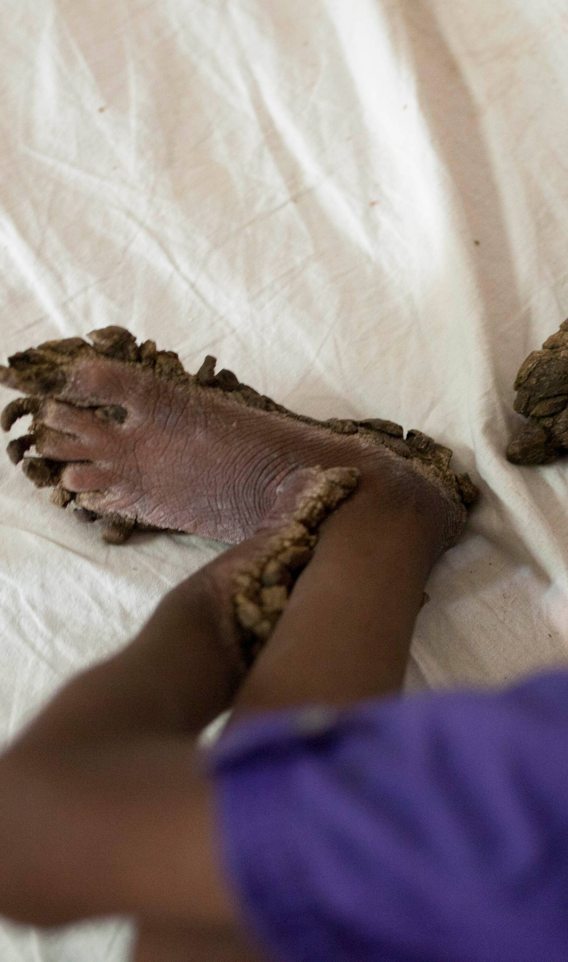 7-Year Old Boy With Tree-Man Illness In Bangladesh