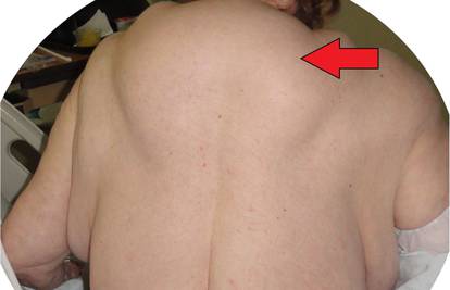 Evo što radi alkohol: Žena (64) je na leđima i vratu dobila grbe