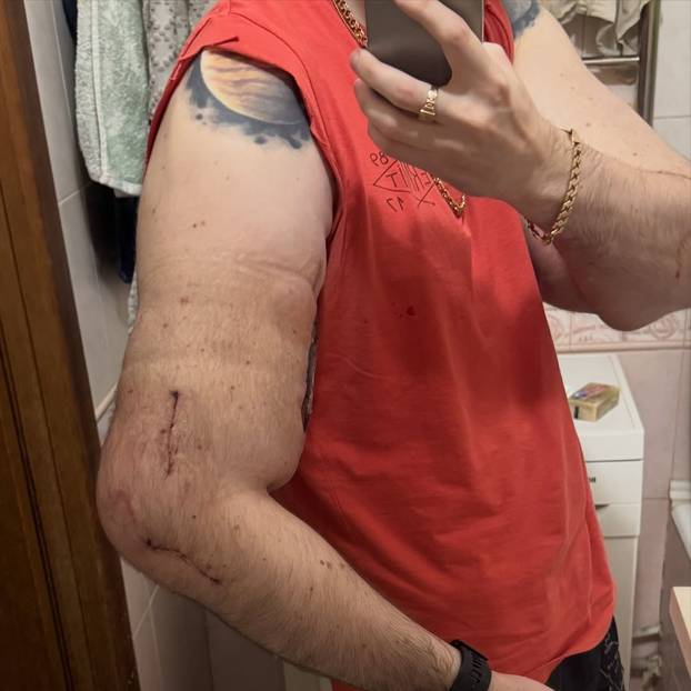 FOTO 'Ruski Popaj' mogao bi izgubiti obje ruke zbog teške infekcije: Ubrizgava kemikalije!