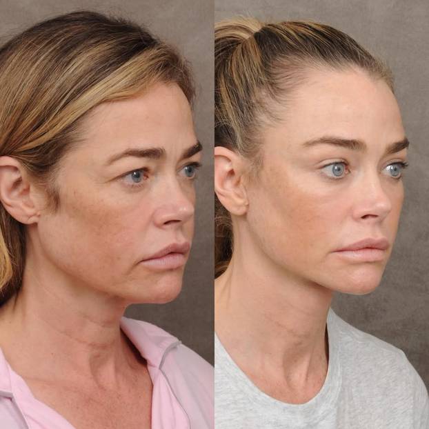 Denise Richards na faceliftingu: Sheenova bivša pokazala je fotke prije i poslije zahvata