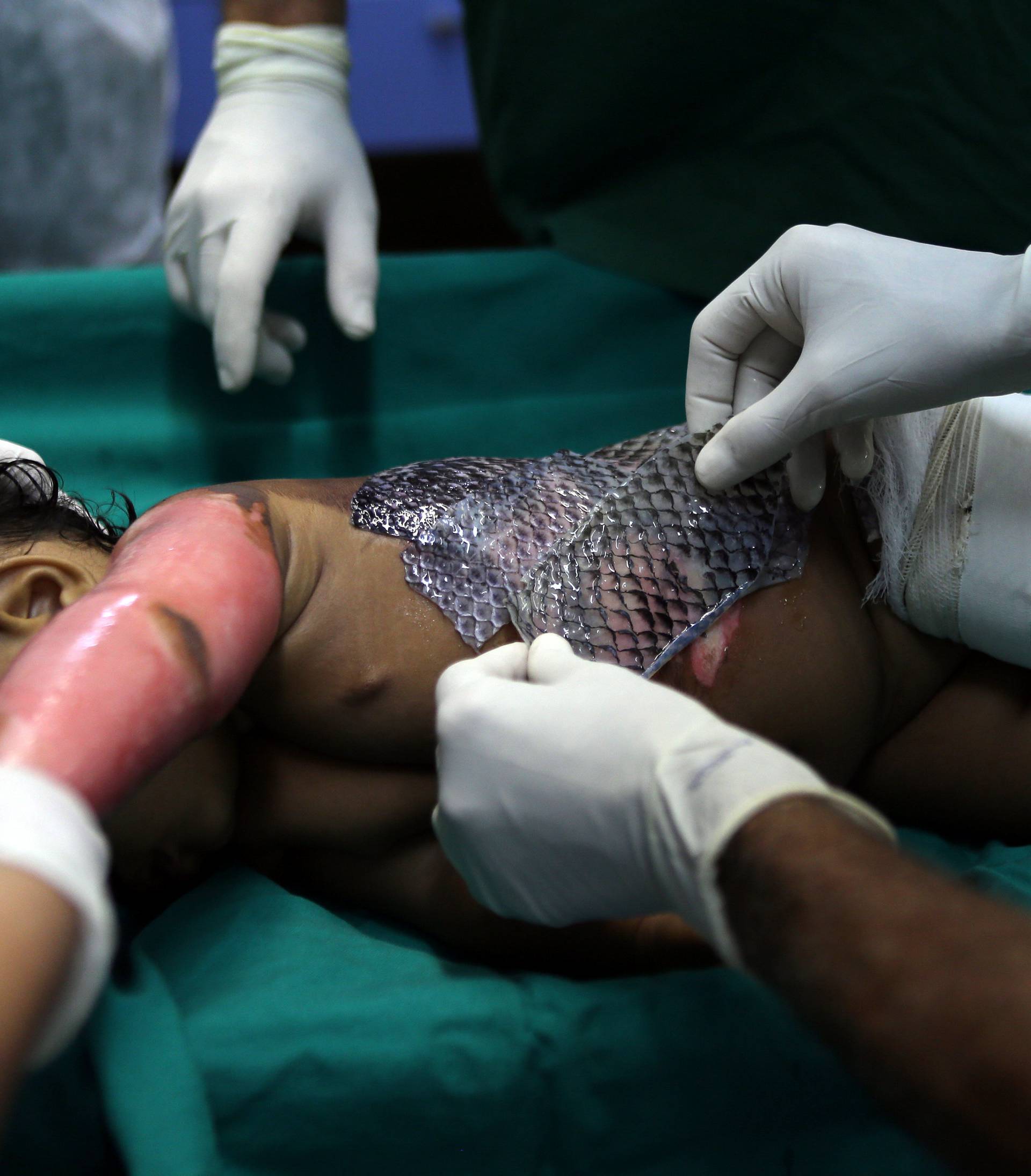 The Wider Image: Healing burns with fish skin