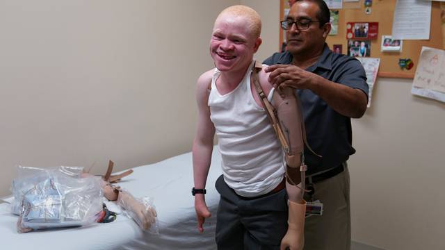 A worker helps Emmanuel Rutema, a Tanzanian with Albinism who had his arm chopped off in a superstition-driven attack, put on a new prosthetic arm at the Shriners Hospital in Philadelphia, Pennsylvani