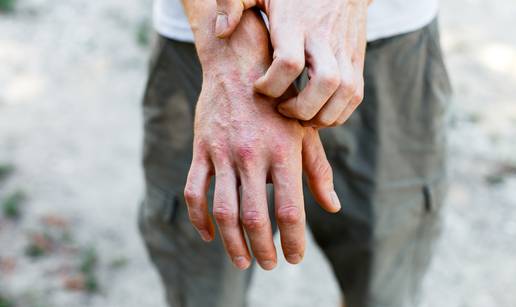 15 savjeta kako pomoći sebi i djeci s atopijskim dermatitisom