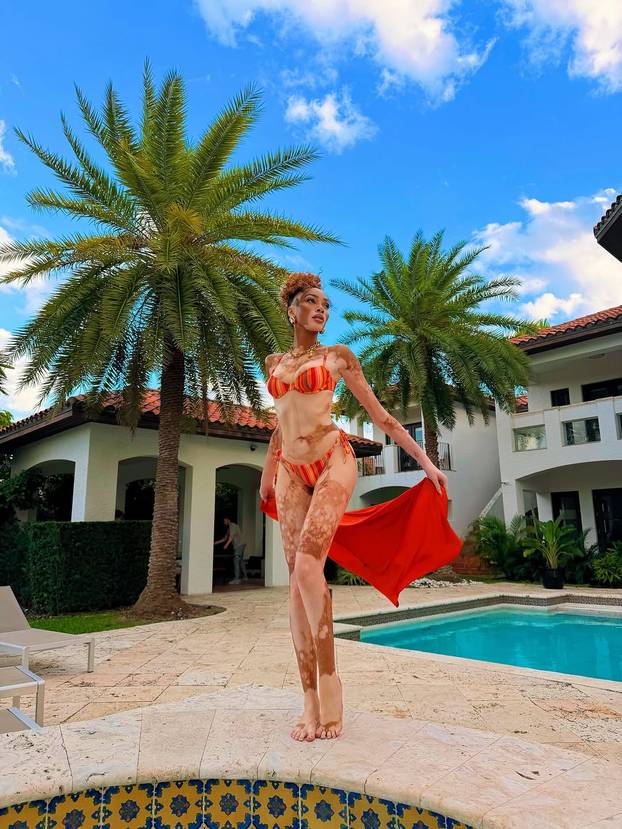 FOTO Rugali su joj se zbog bolesti, a danas je obožavaju zbog jedinstvenog izgleda