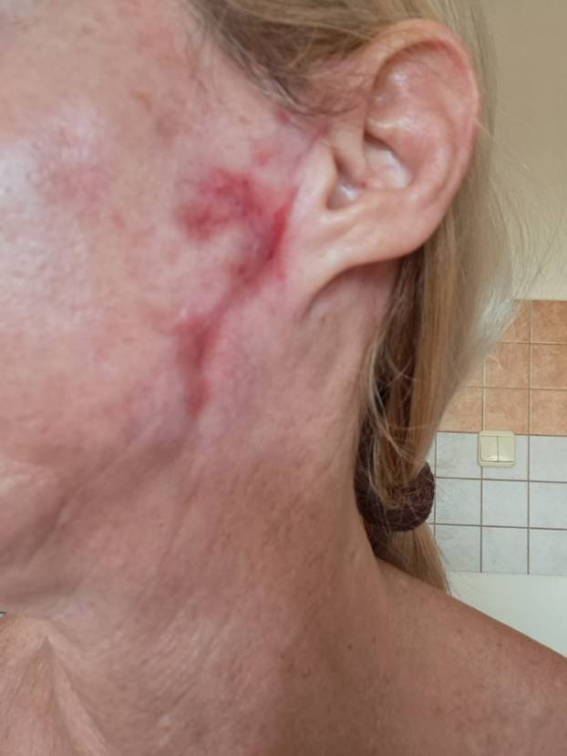 Na istog se estetskog kirurga žalila i Kristina Mandarina. Pogledajte kako je izgledala