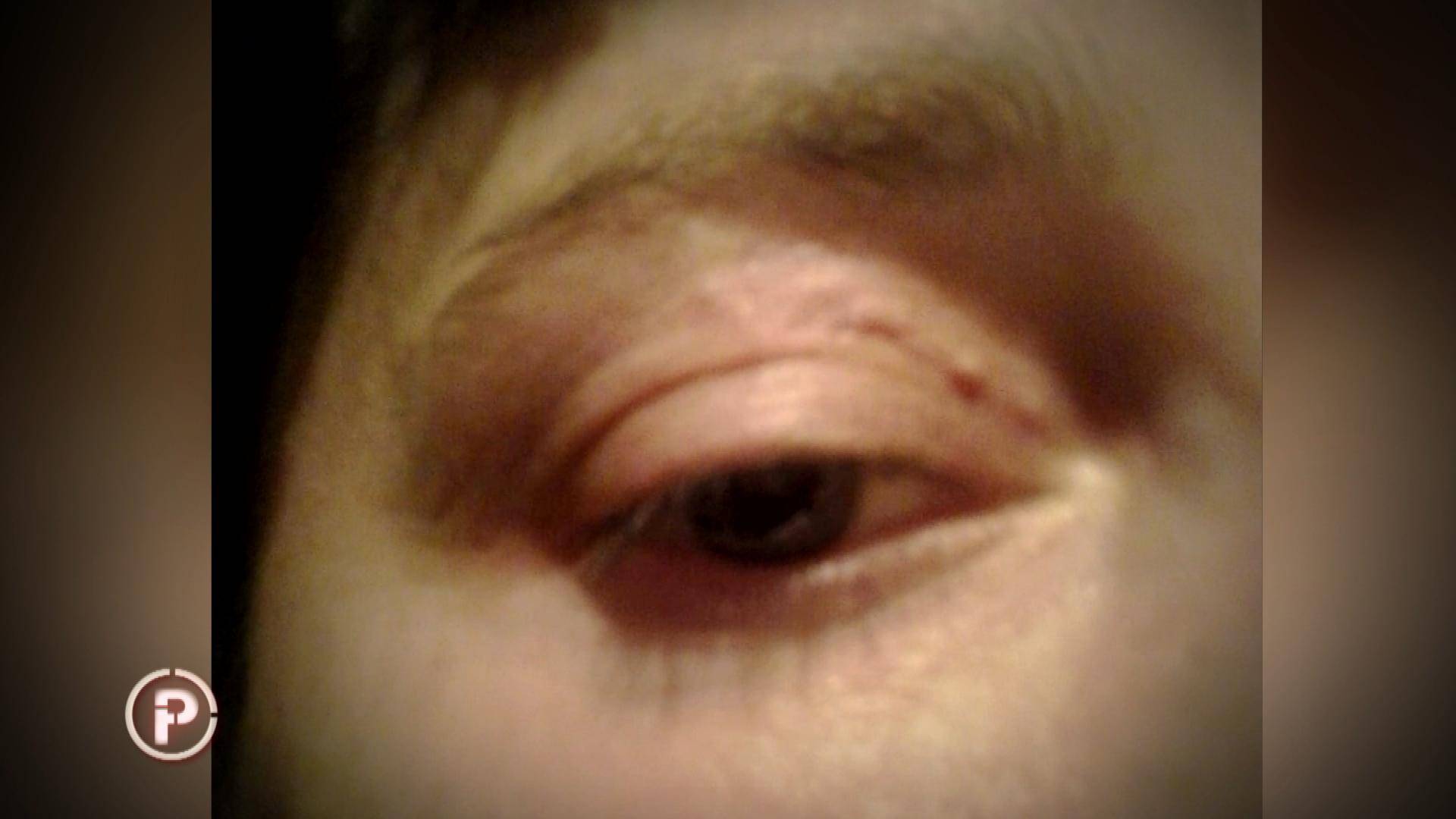 Mireli je ugriz komarca 'donio' crva u oku: 'Osjetim gmizanje'