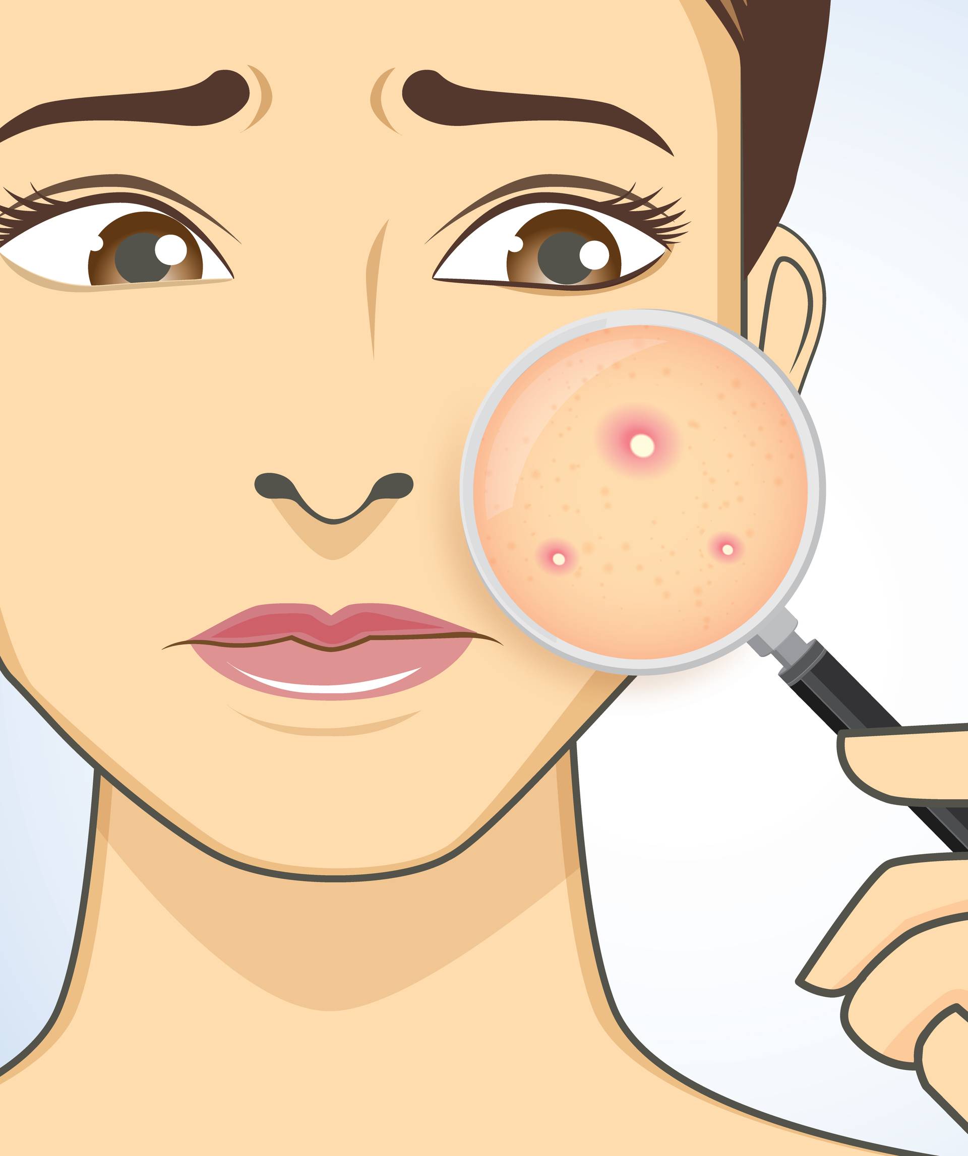 Akne - njihovo mjesto na licu otkriva vaše unutarnje tegobe