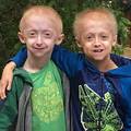 Rijetka bolest: Braća od 9 i 13 godina izgledaju poput starčića